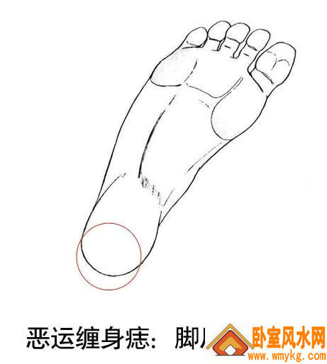 脚后跟有胎记 脚后跟有胎记